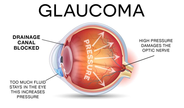 GLAUCOMA & THE WEST AFRICAN GENE